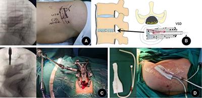 Treatment of lumbar brucella spondylitis with negative pressure wound therapy via extreme lateral approach: A case report